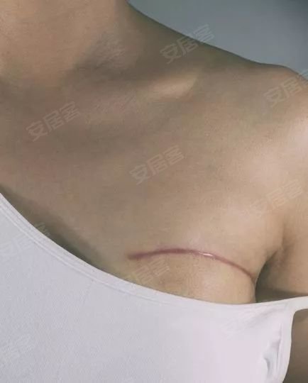 日本新型乳腺癌治疗法:冻死癌细胞,伤口极小且复发率极低!